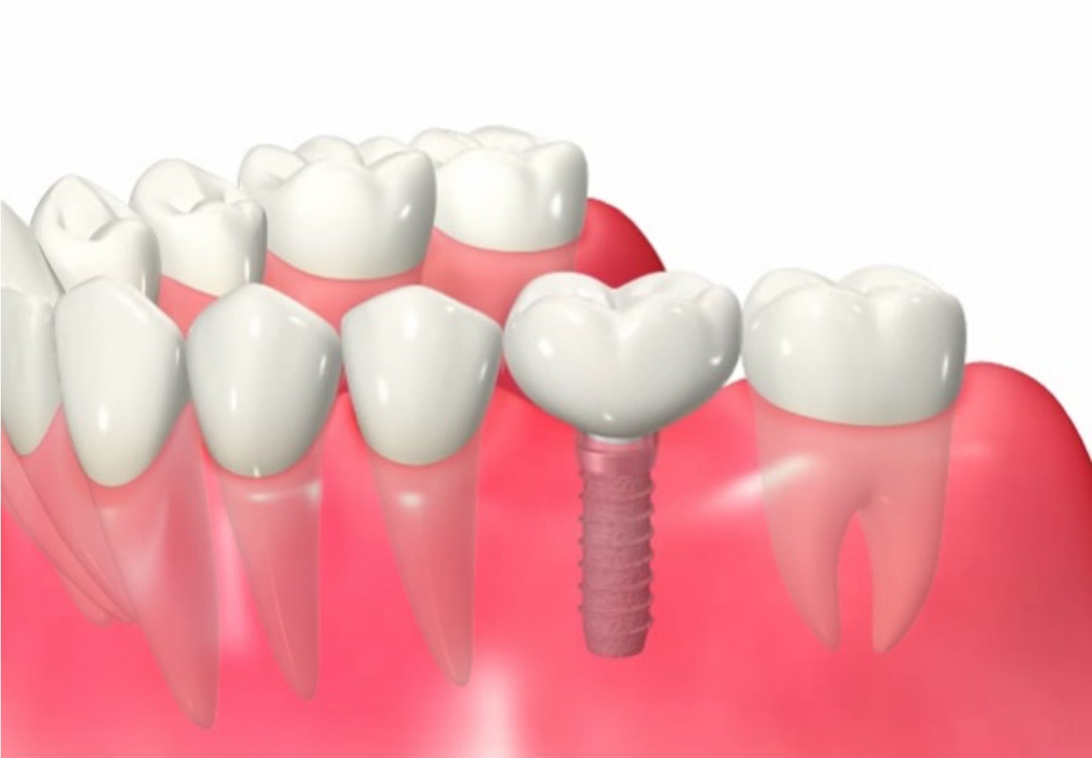 implant merit
